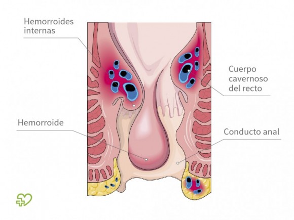 HEMORROIDES2