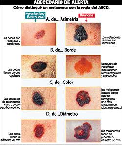 melanoma01